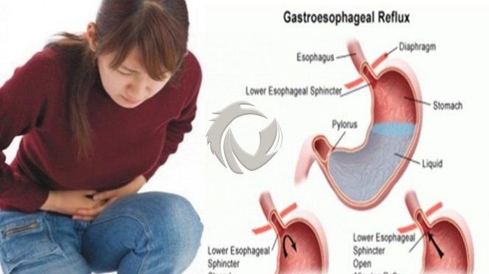 3 Cara Mengatasi Asam Lambung Dengan Cepat